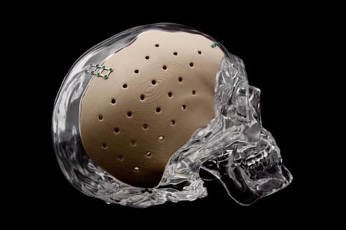 Patient specific OsteoFab cranial implant 3D-printed
